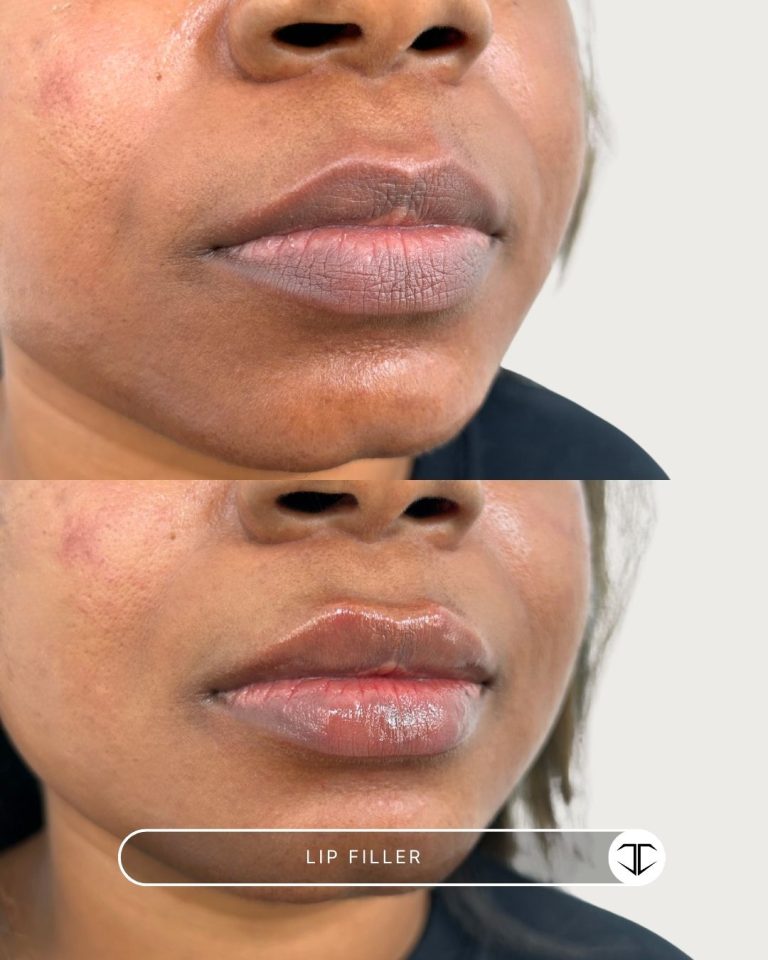 Lip Filler Before and After