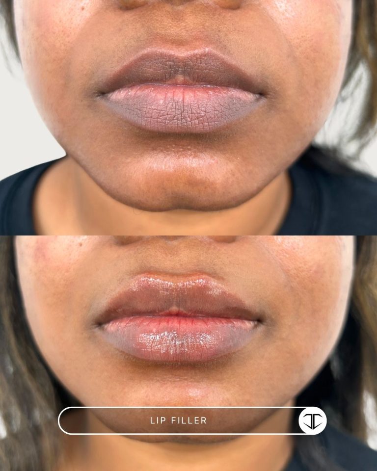 Lip Filler Before and After