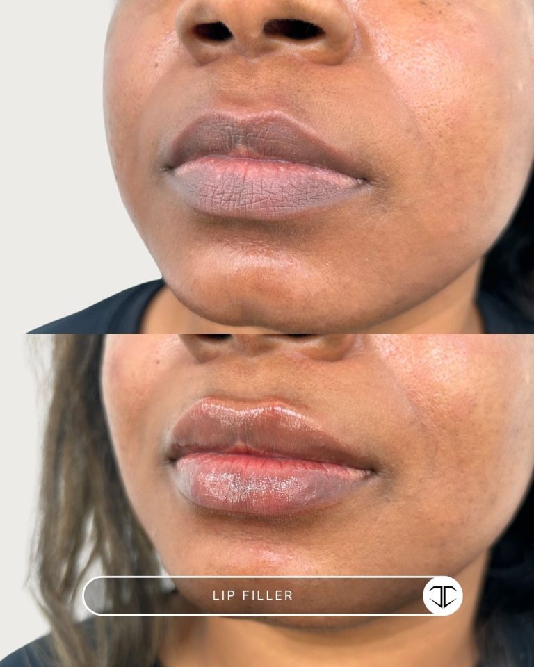 Lip Filler Before and After