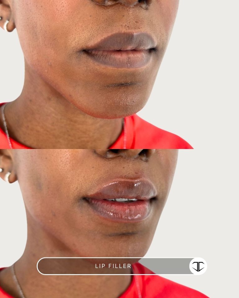 Lip Filler Before and After