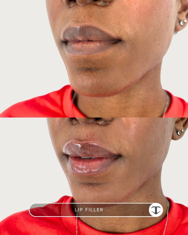Lip Filler Before and After
