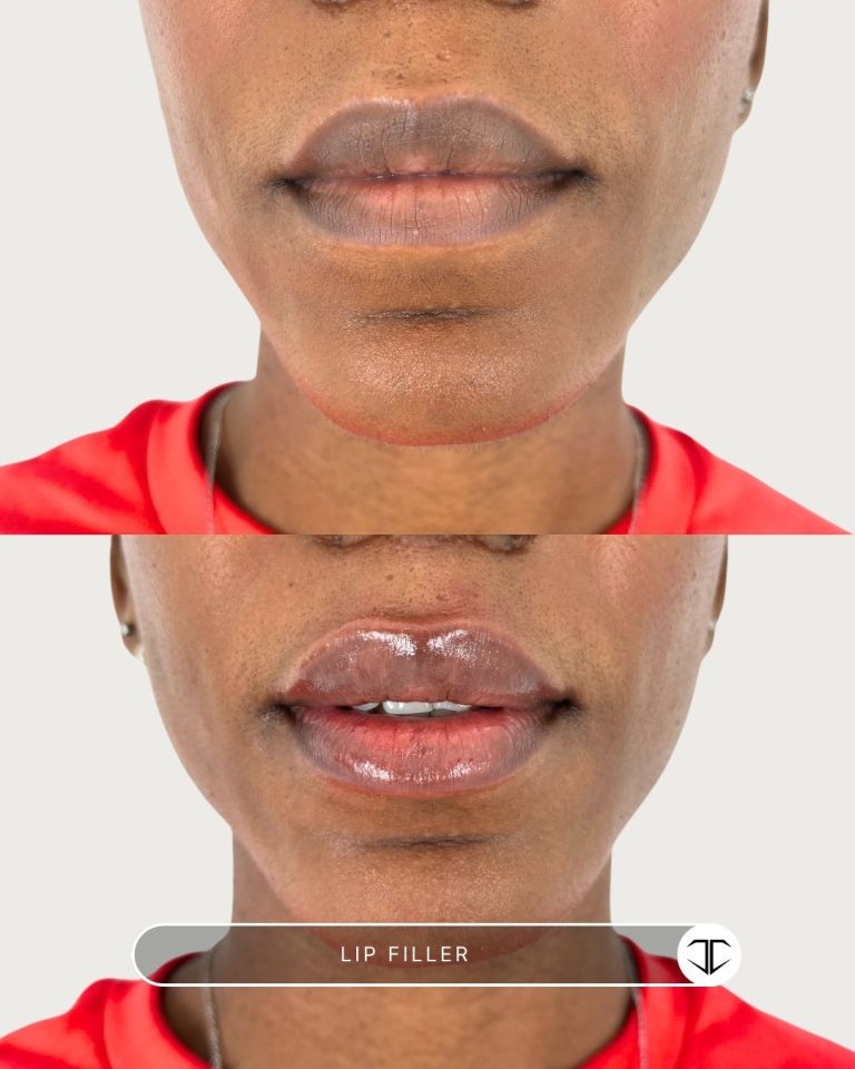 Lip Filler Before and After