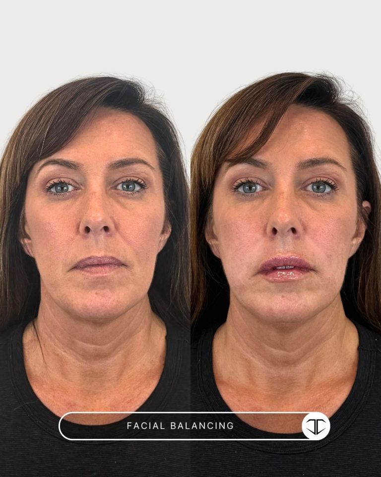 Facial Balancing Before and After