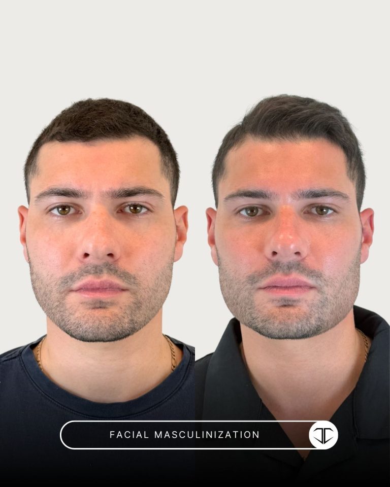 Facial Masculinization