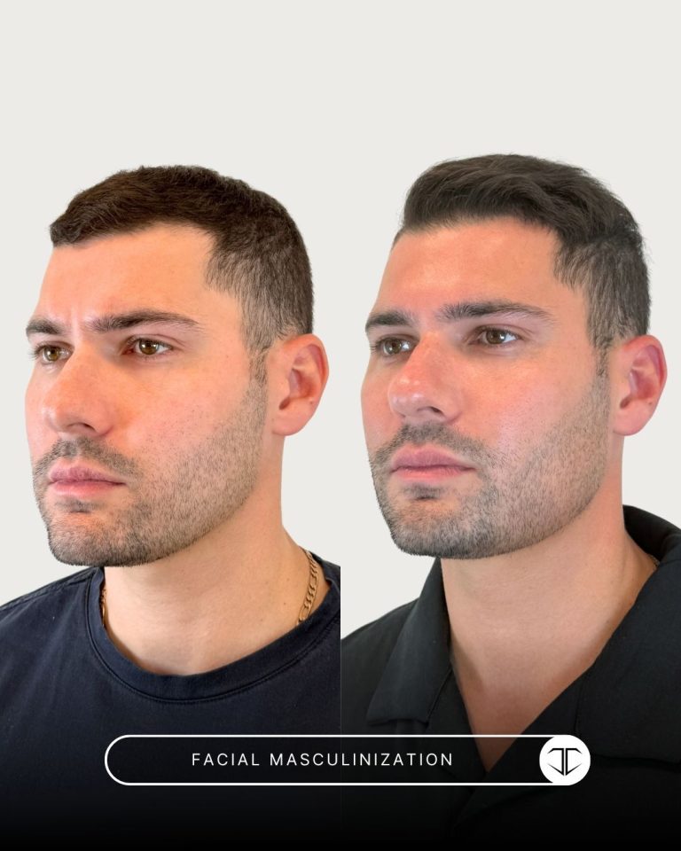 Facial Masculinization