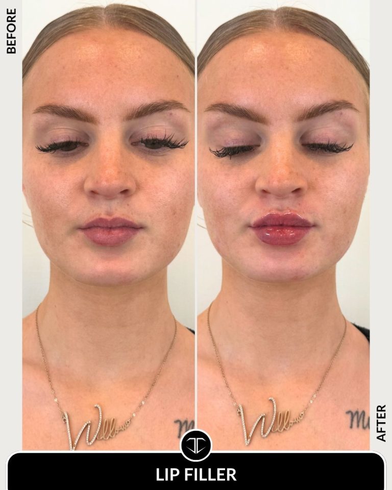 Lip Filler Before and After