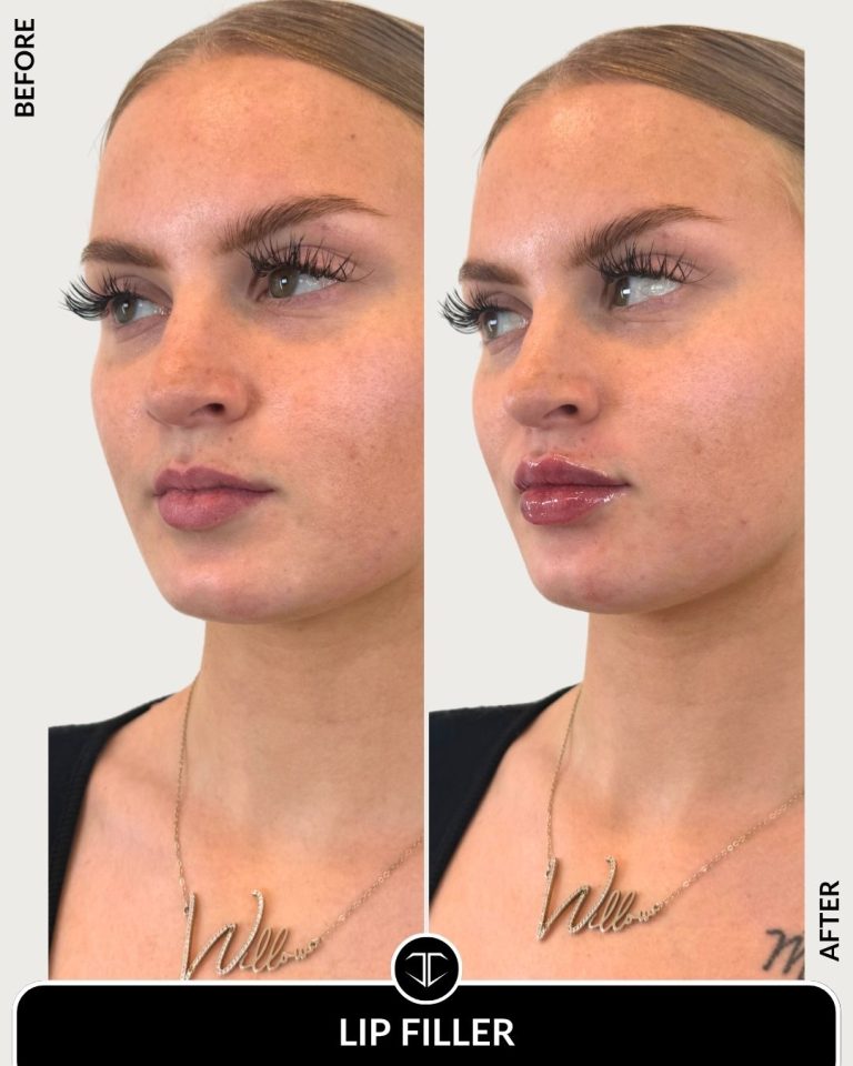 Lip Filler Before and After