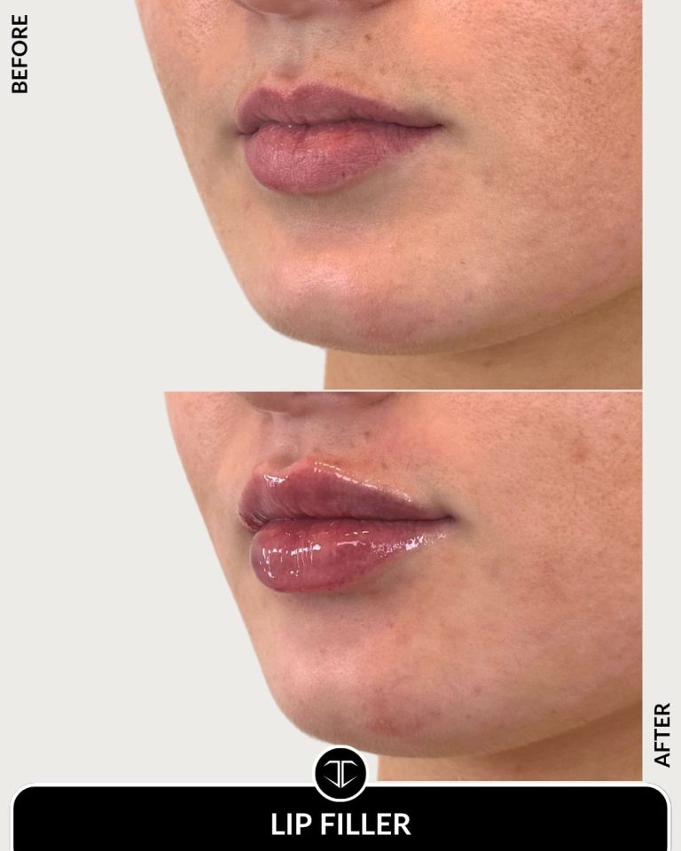 Lip Filler Before and After