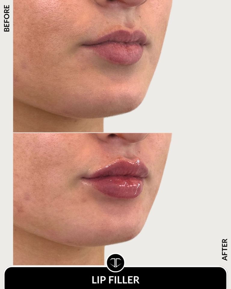 Lip Filler Before and After