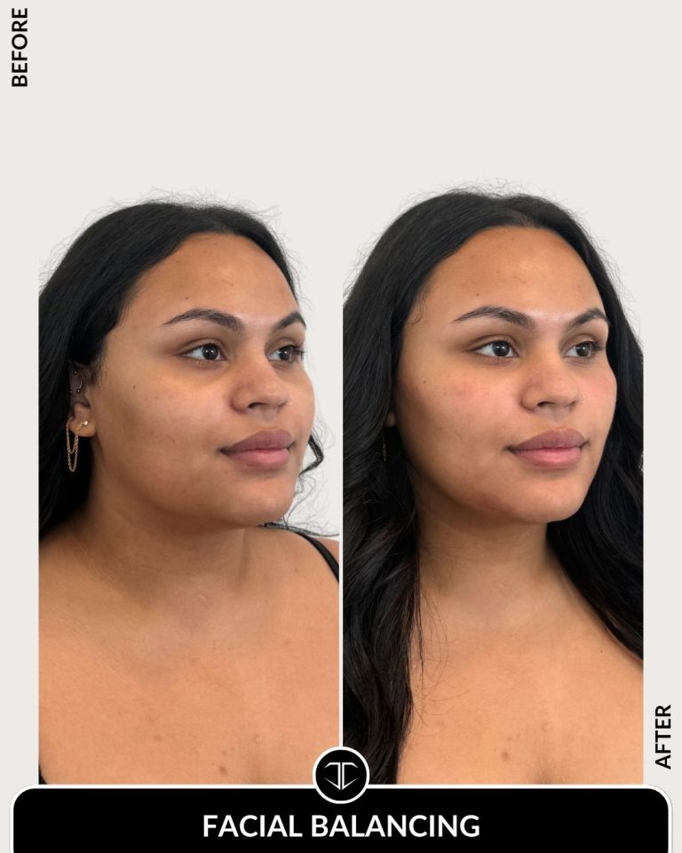Facial Balancing Before and After