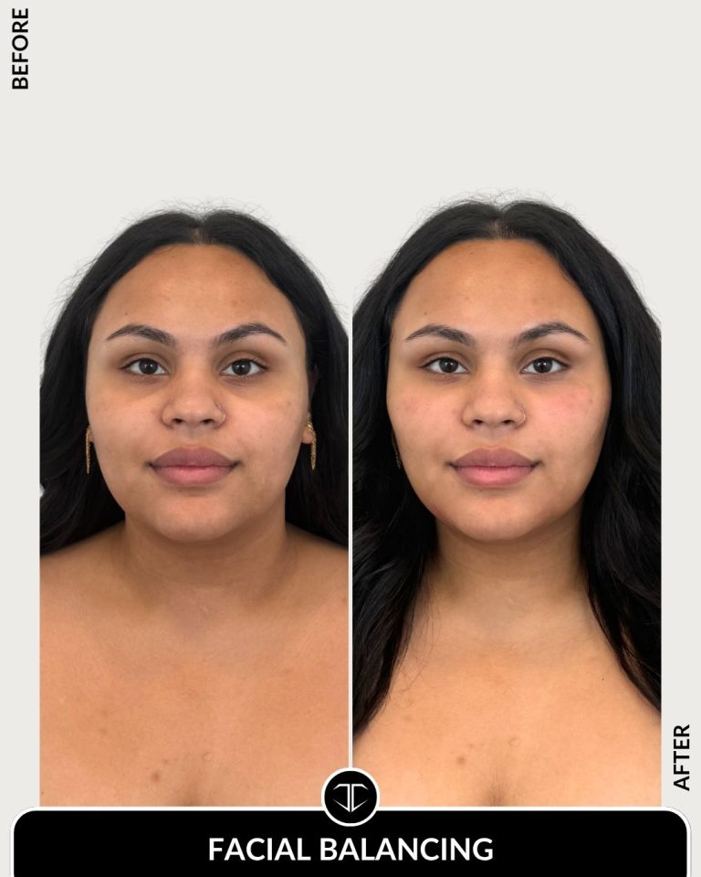Facial Balancing Before and After