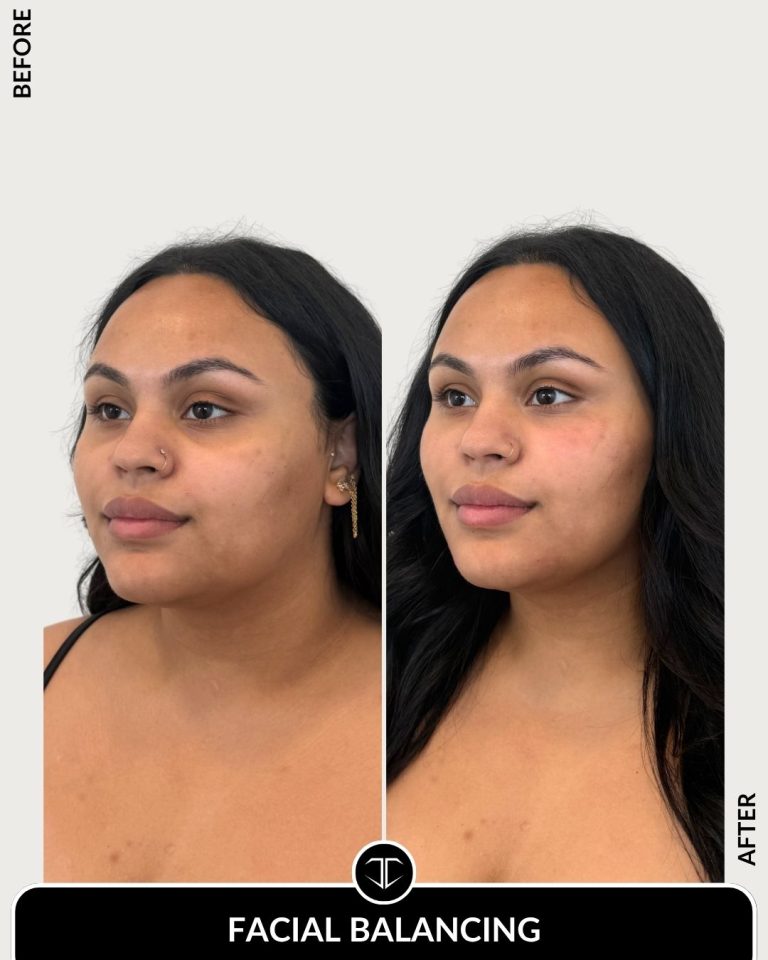 Facial Balancing Before and After
