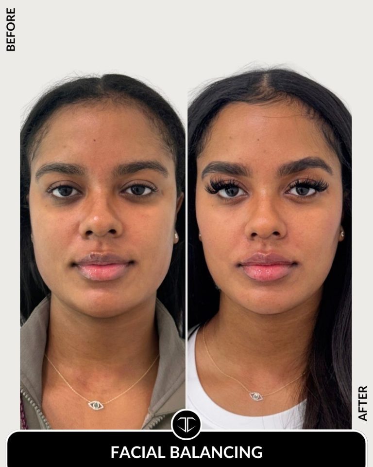 Facial Balancing Before and After