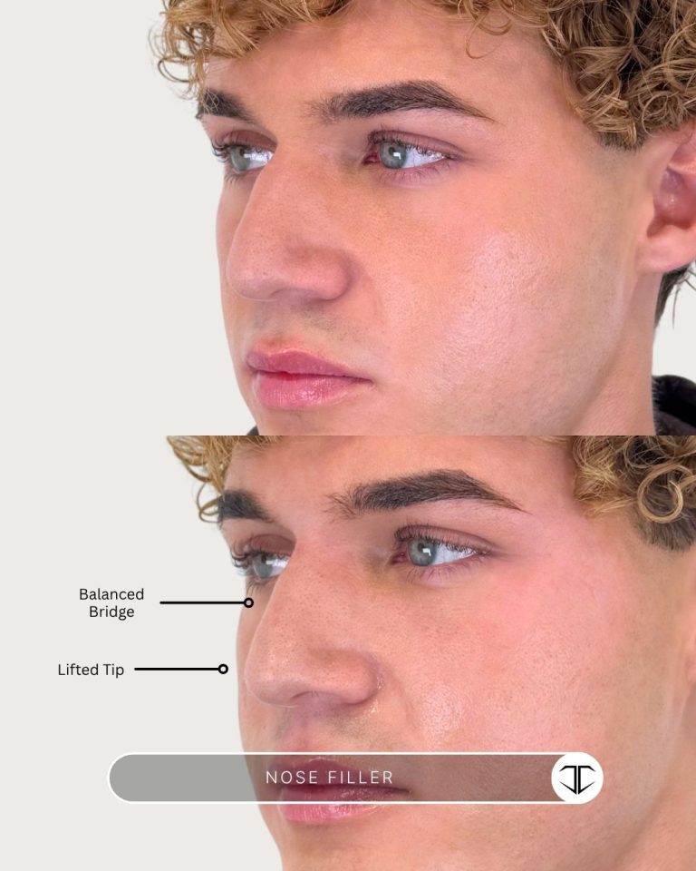 Nose Filler Before and After