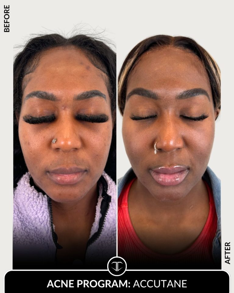 Accutane Acne Program Before and After