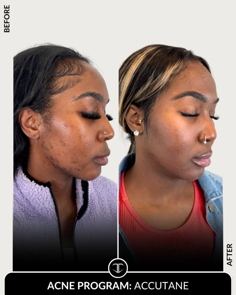 Accutane Acne Program Before and After