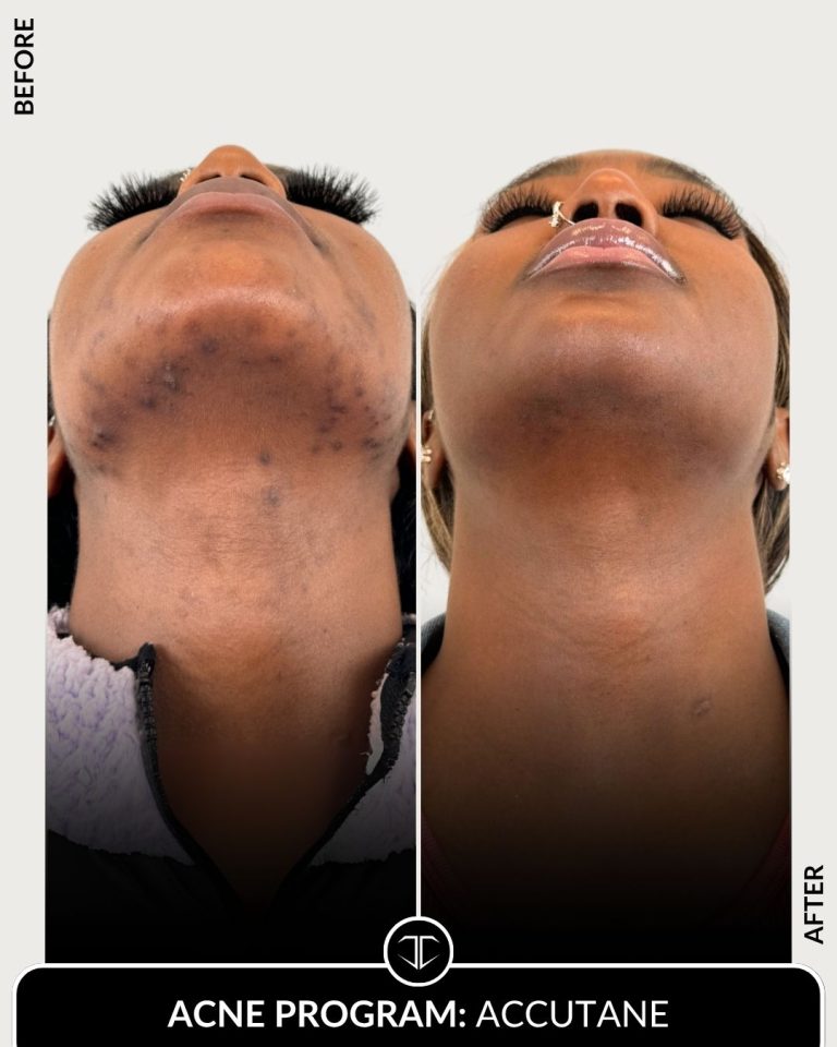 Accutane Acne Program Before and After