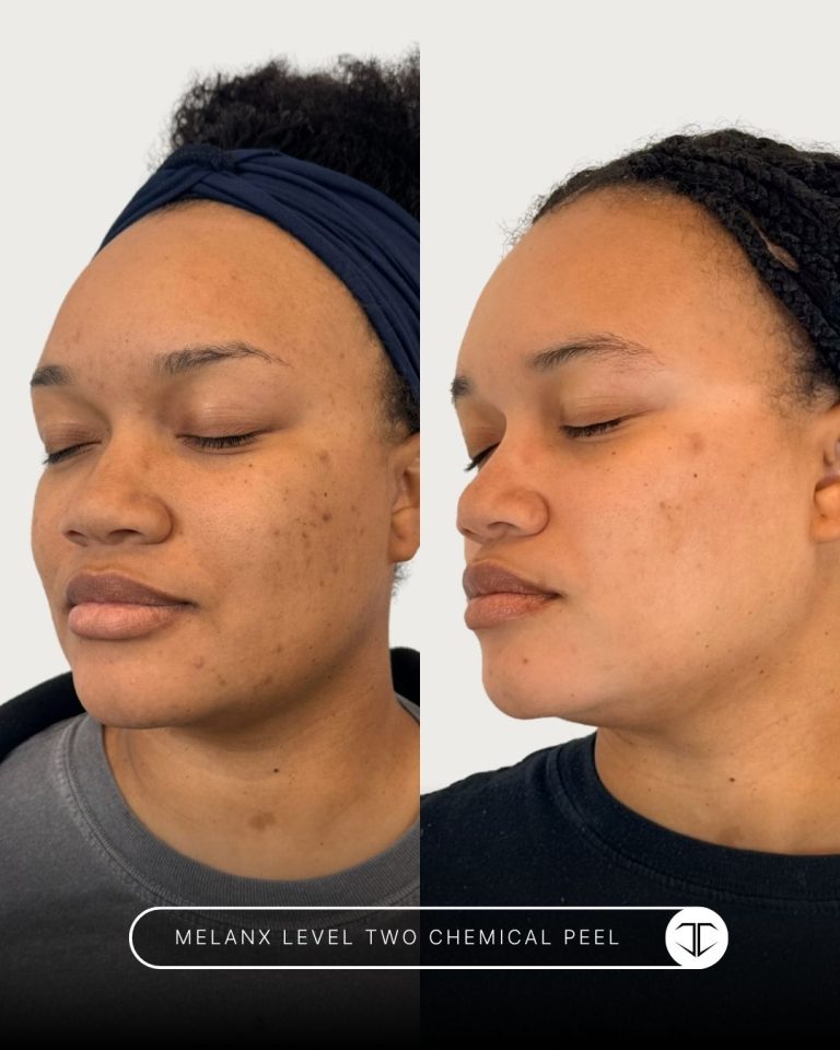 Melanx Level 2 Chemical Peel Before and After