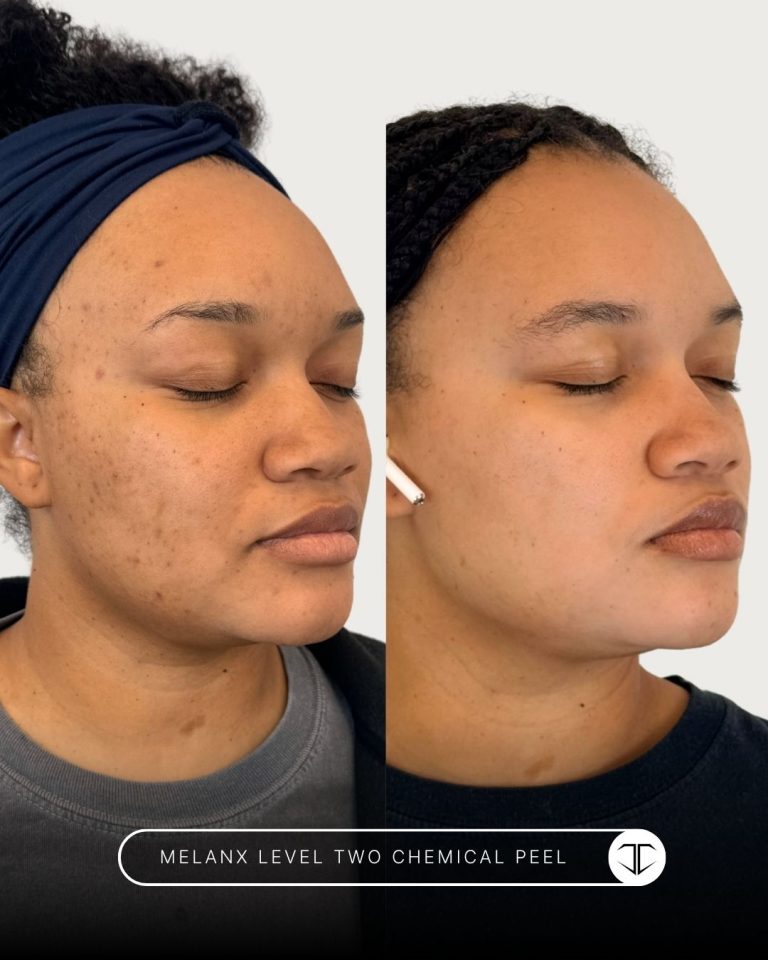 Melanx Level 2 Chemical Peel Before and After