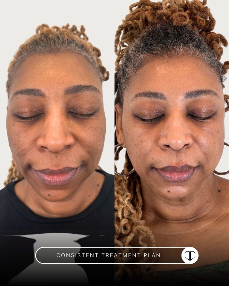 Consistent Treatment Before and After