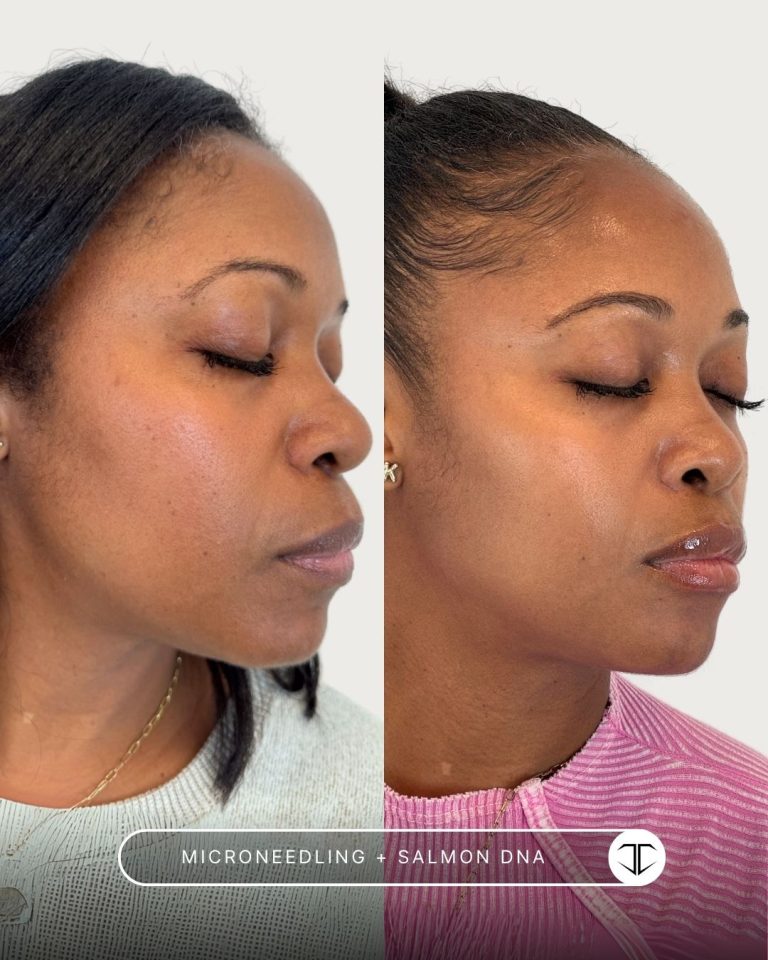 Microneedling + Salmon DNA Before and After