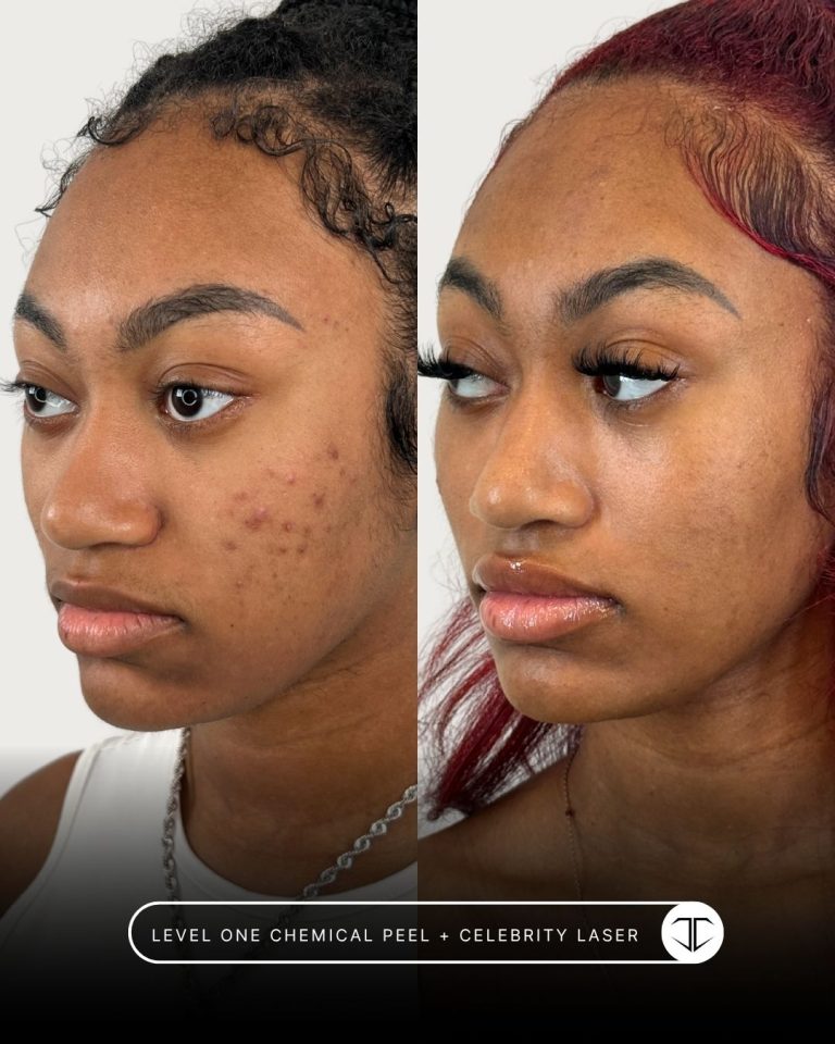 Level one Chemical Peel + Celebrity Laser treatment before and after
