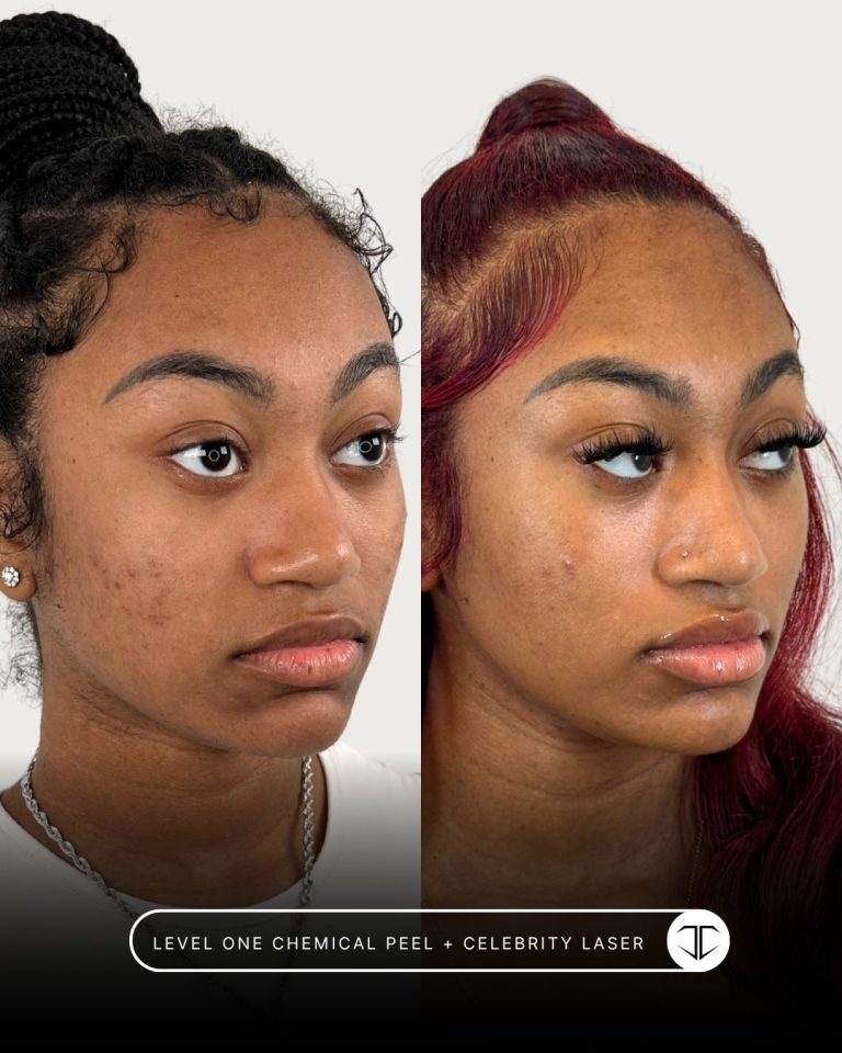 Level one Chemical Peel + Celebrity Laser treatment before and after