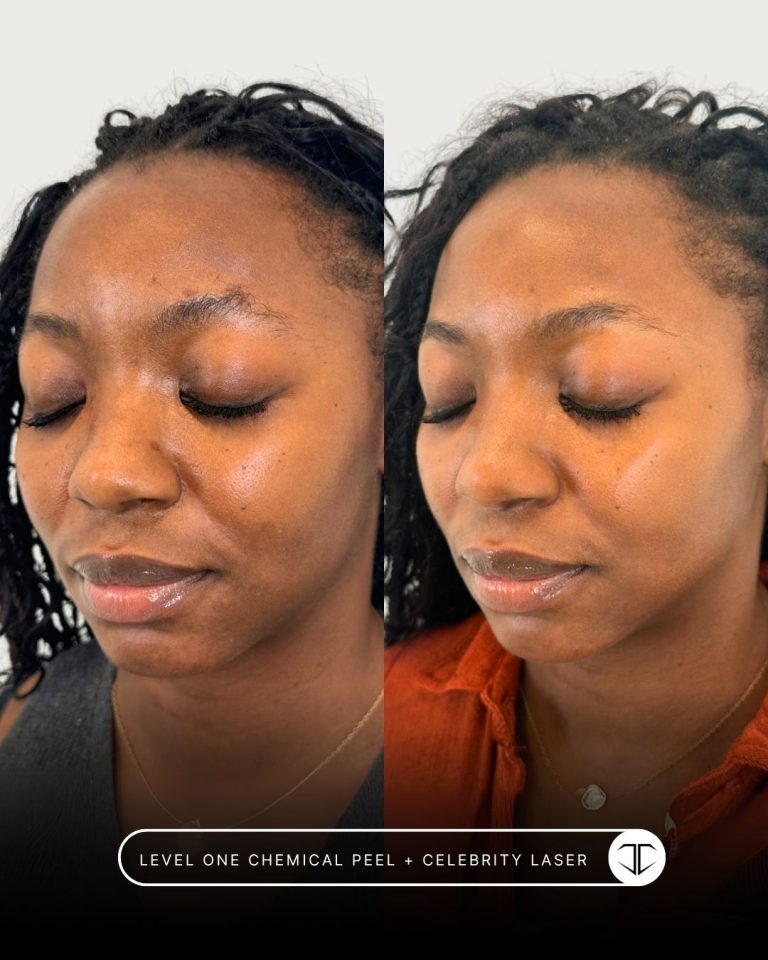 Level one Chemical Peel + Celebrity Laser treatment before and after