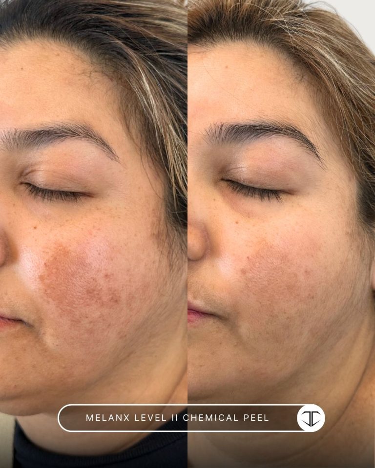 Melanx Level 2 Chemical Peel