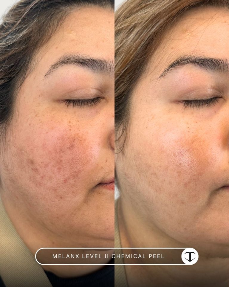 Melanx Level 2 Chemical Peel