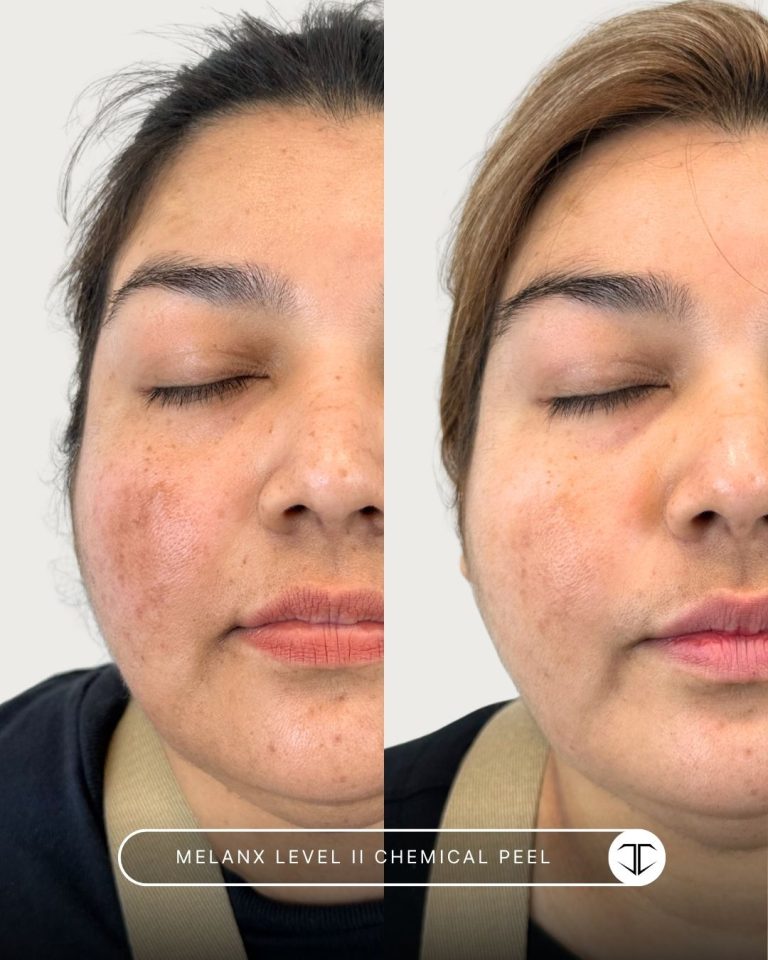 Melanx Level 2 Chemical Peel