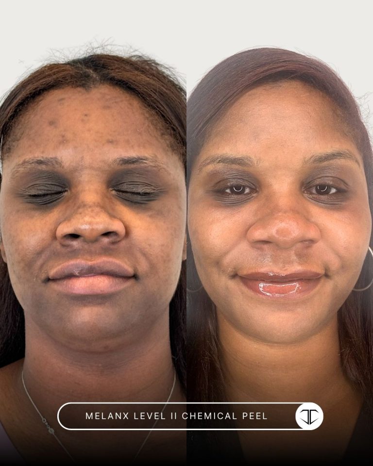 Melanx Level 2 Chemical Peel Before and After