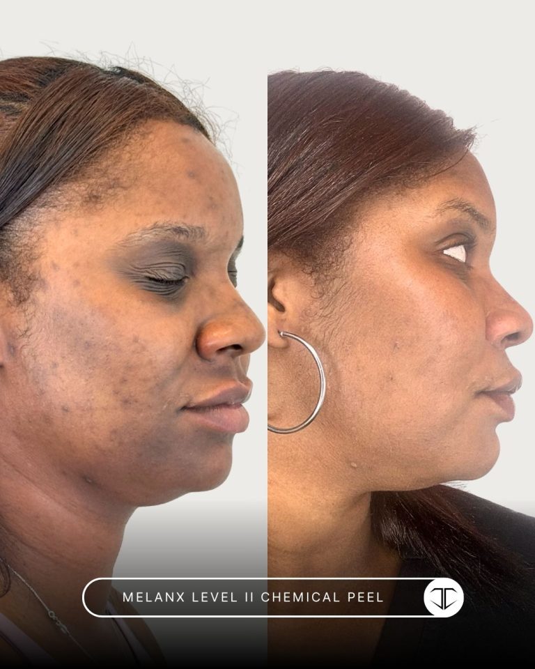 Melanx Level 2 Chemical Peel Before and After