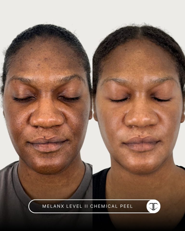 Melanx Level 2 Chemical Peel Before and After