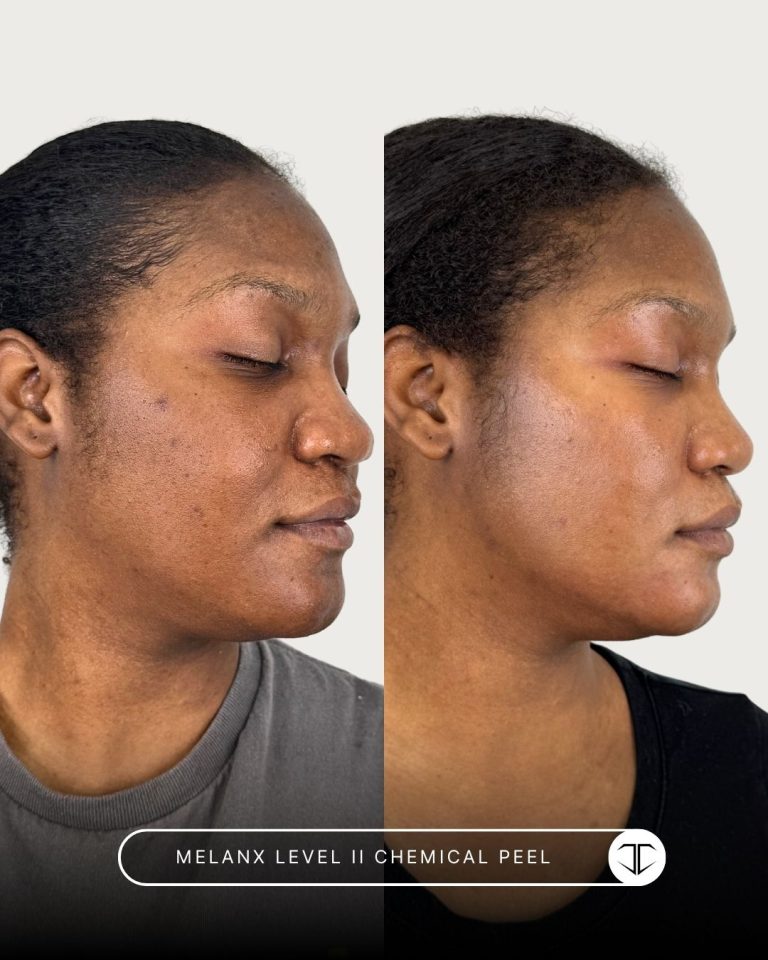 Melanx Level 2 Chemical Peel Before and After