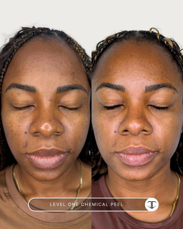 Level 1 Chemical Peel Before and After