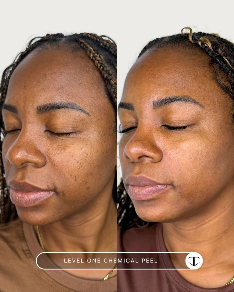 Level 1 Chemical Peel Before and After