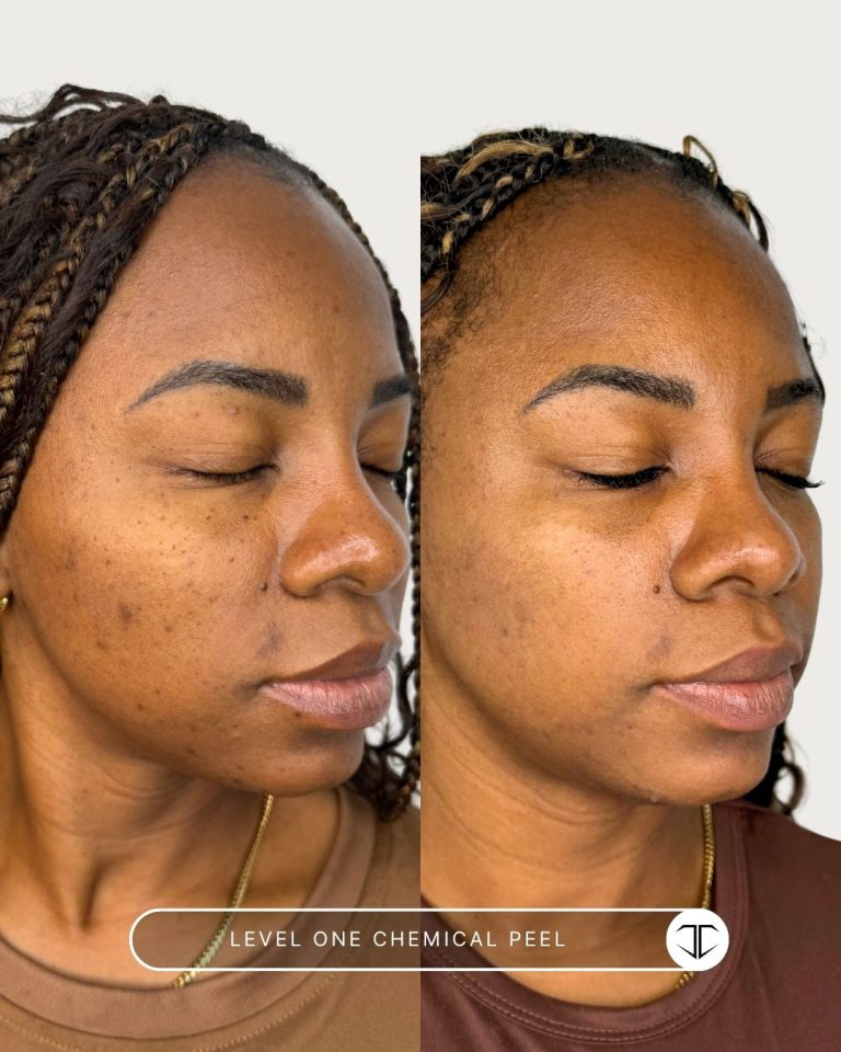 Level 1 Chemical Peel Before and After