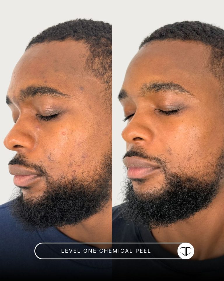 Level 1 Chemical Peel Before and After