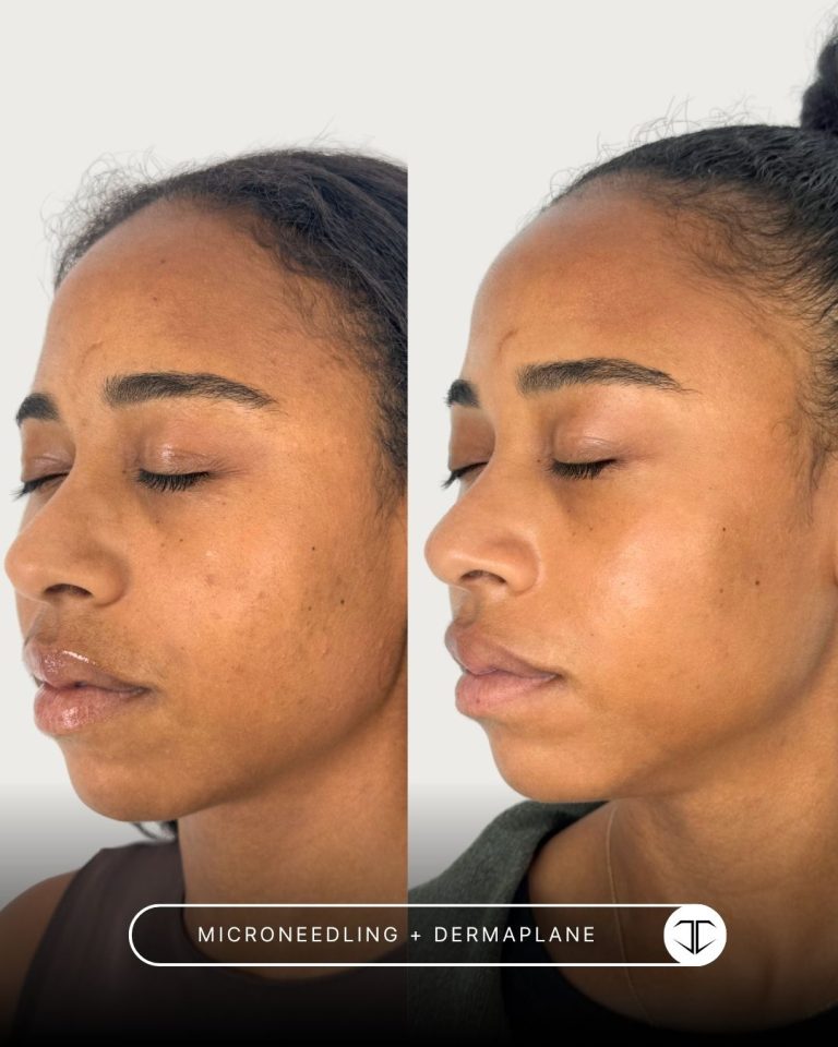 Microneedling + dermaplaning before and after
