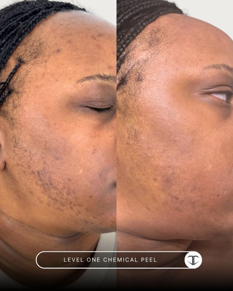 Level one chemical peel before and after