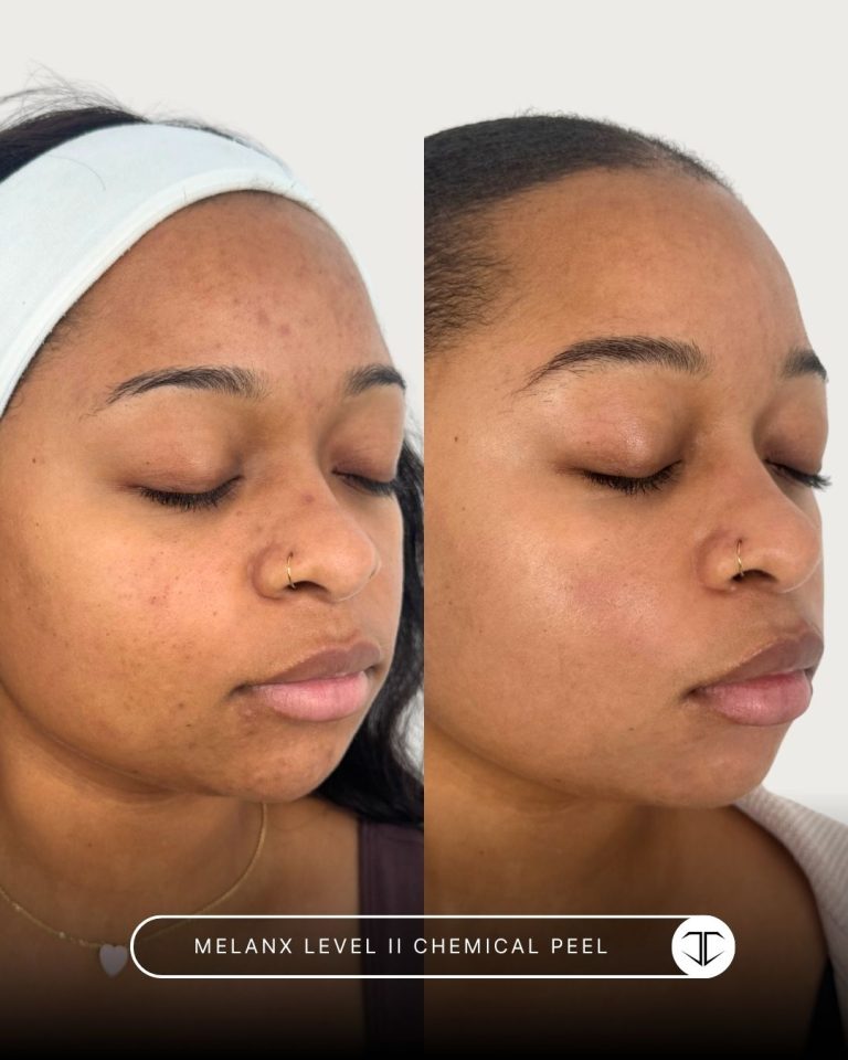Melanx Level 2 Chemical Peel Before and After