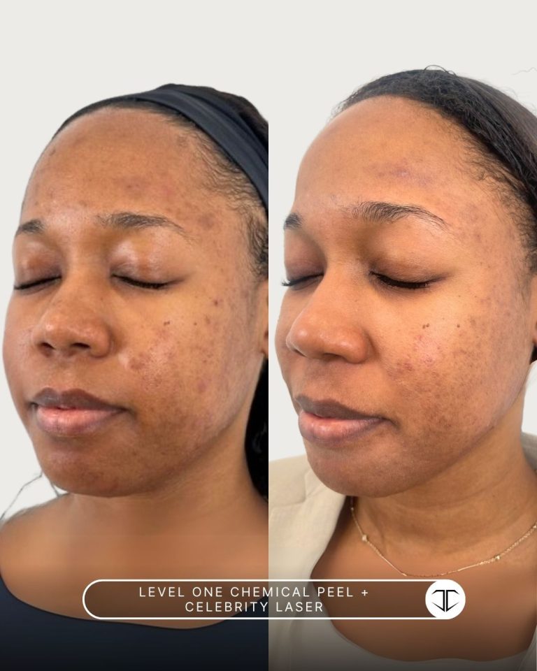 Level one Chemical Peel + Celebrity Laser treatment before and after