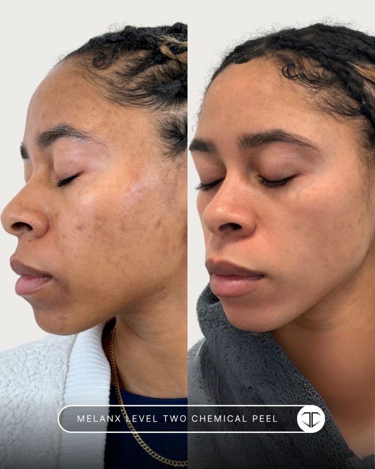 Melanx Level 2 Chemical Peel Before and After
