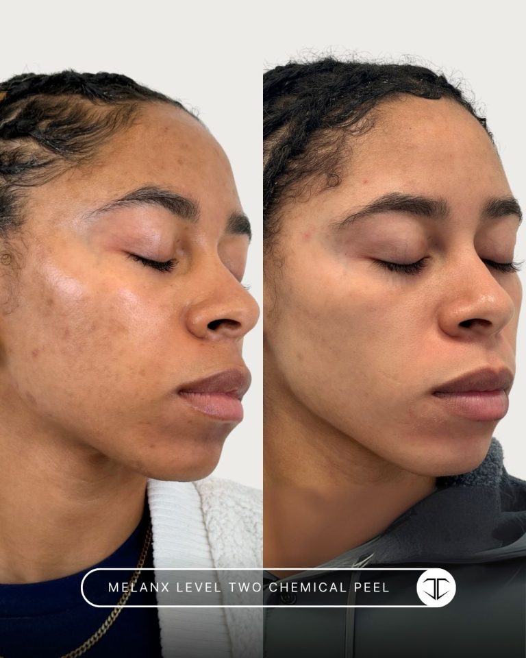 Melanx Level 2 Chemical Peel Before and After