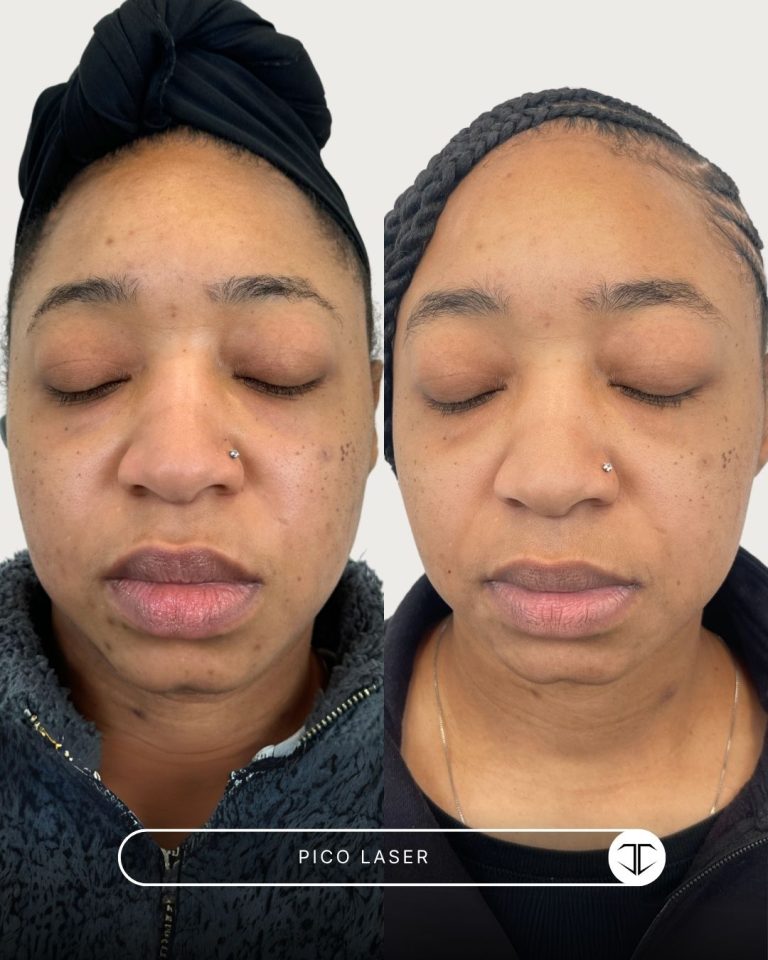 Pico Laser Before and After