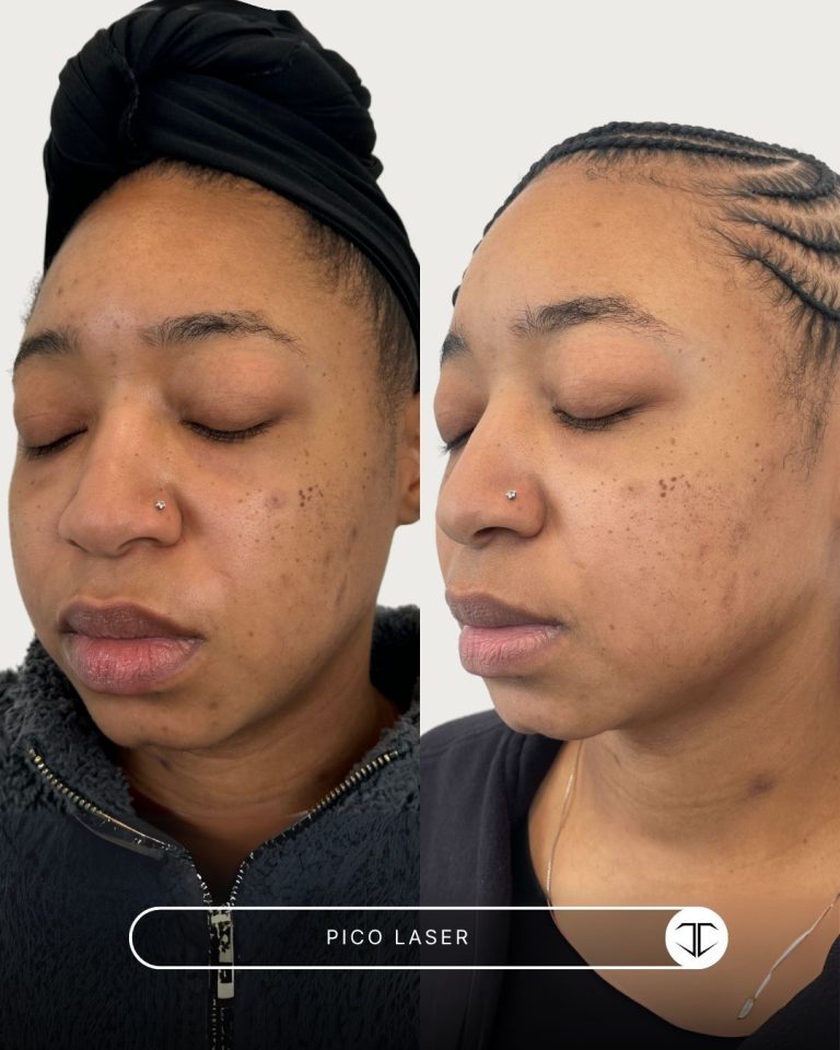 Pico Laser Before and After