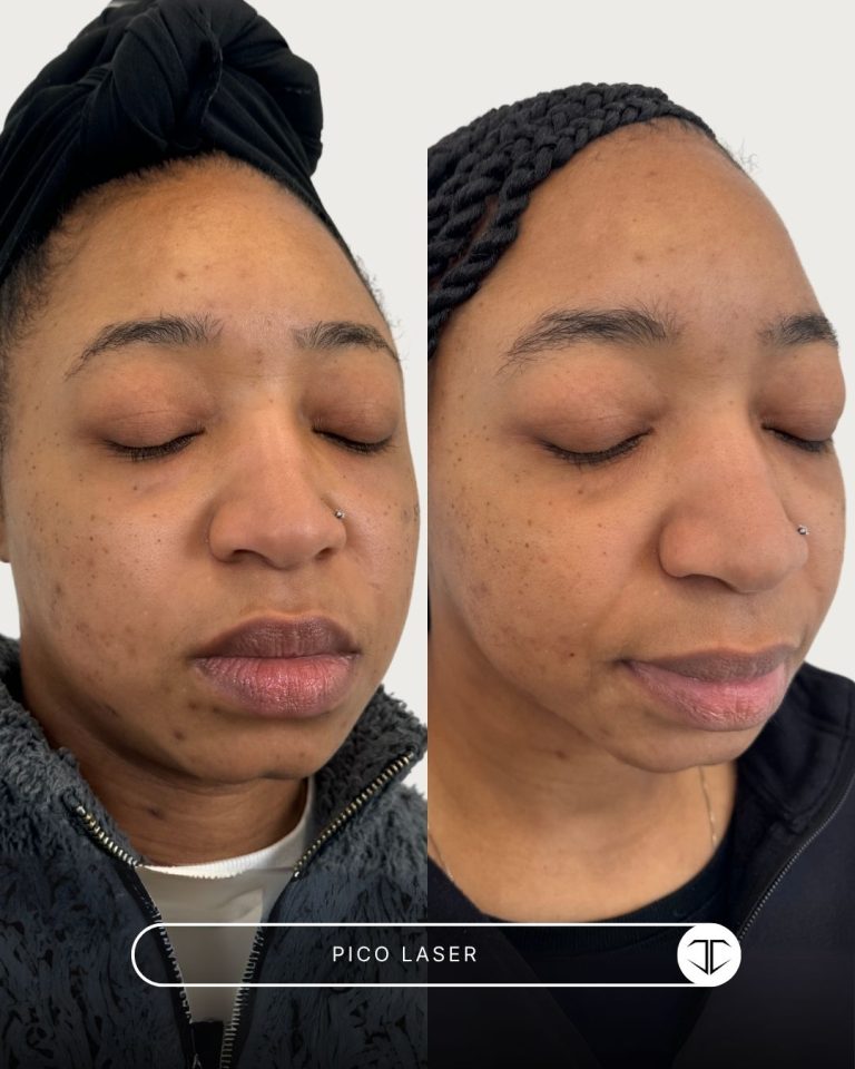 Pico Laser Before and After