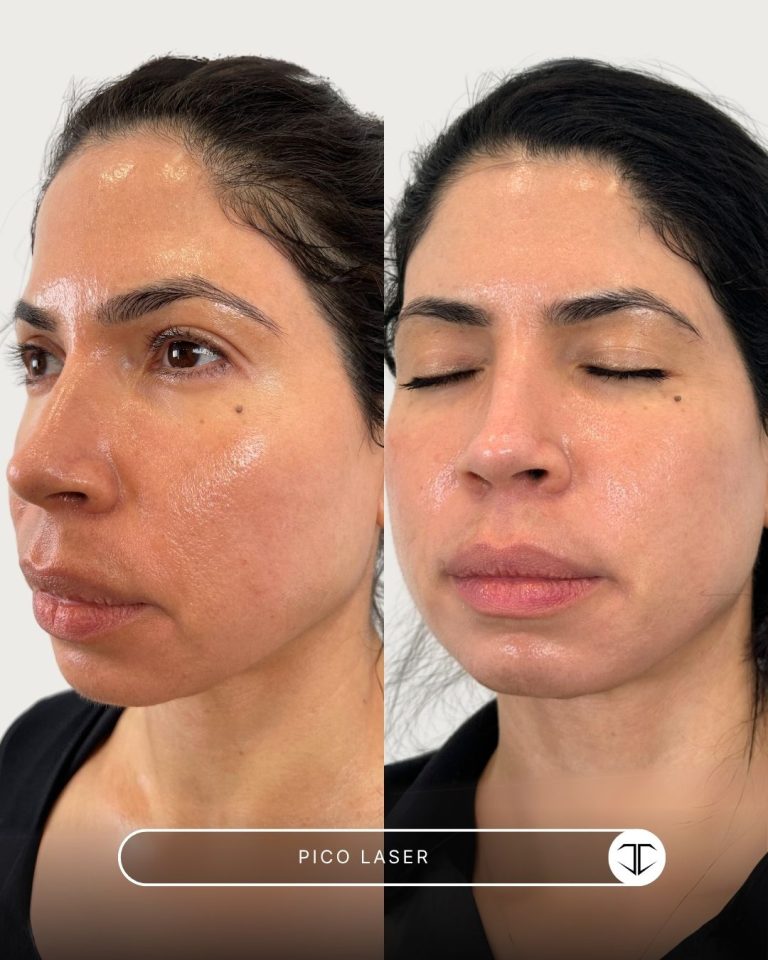 Pico Laser Before and After