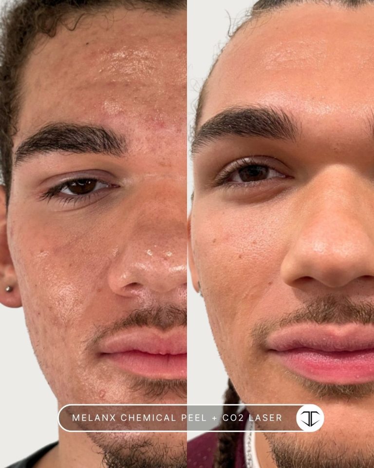 Melanx Chemical Peel + Co2 Laser Before and After